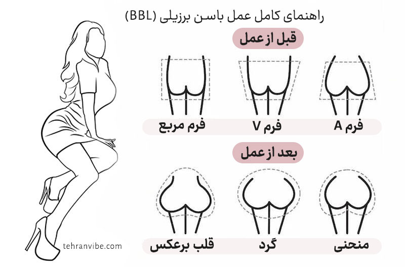 راهنمای کامل عمل باسن برزیلی (BBL)