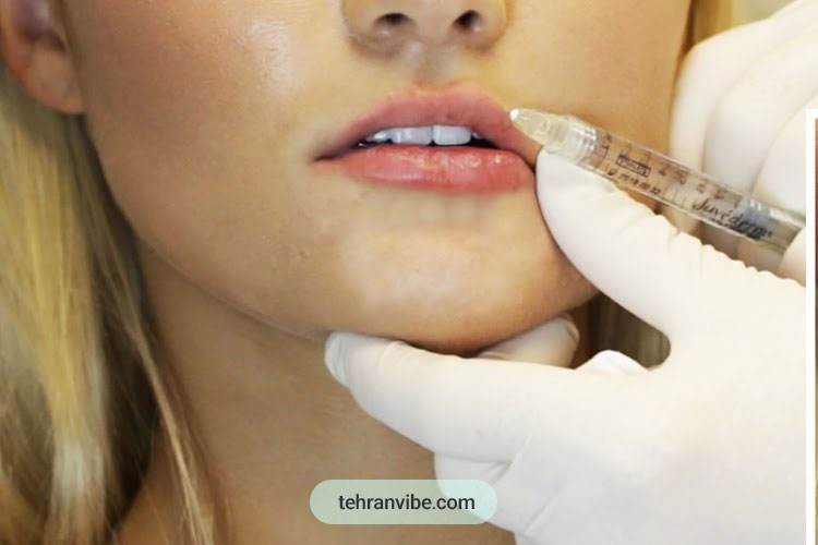 فیلر لب