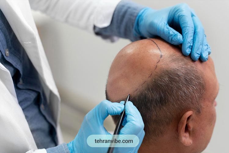 مراقبت های قبل از کاشت مو